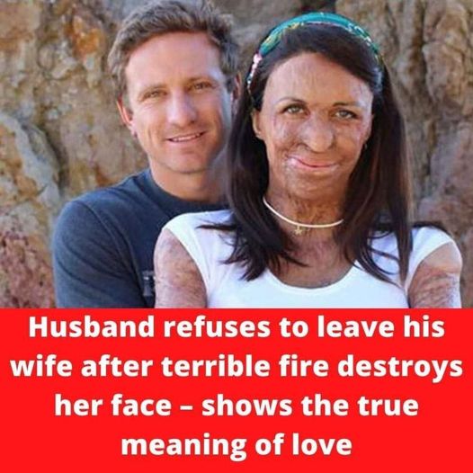 Husband refuses to leave his wife after terrible fire destroys her face – shows the true meaning of love