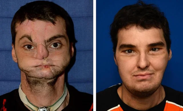 Transformation Before And After Photos of Richard Lee Norris’ Face Transplant – It Is Unbelievable