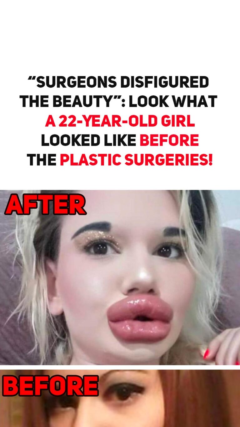 “Surgeons Disfigured The Beauty”: Look What a 22-Year-Old Girl Looked Like Before The Plastic Surgeries!