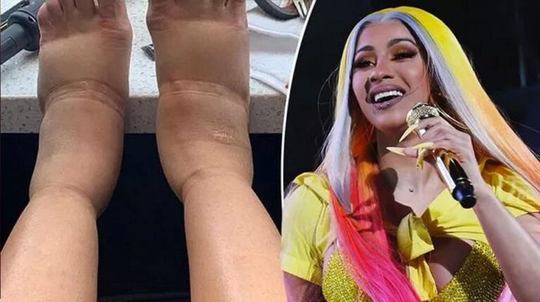 Cardi B reveals extremely swollen feet after pulling out of Parklife Festival