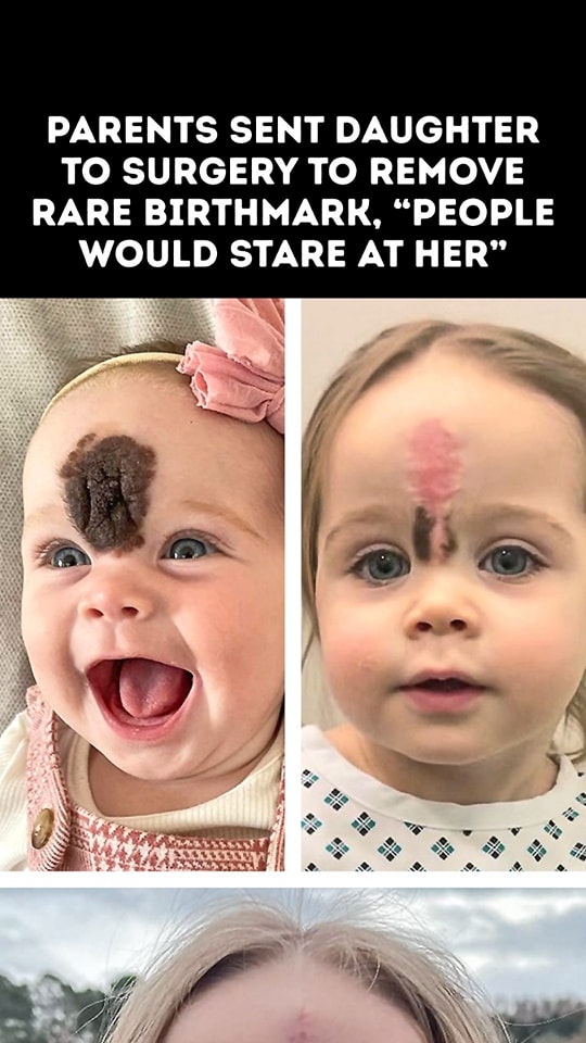 Rare Birthmark: Parents Send Their Daughter to Surgery