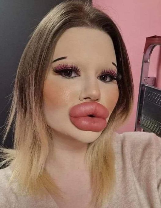24-year-old Bulgarian woman wants to have the biggest lips in the world