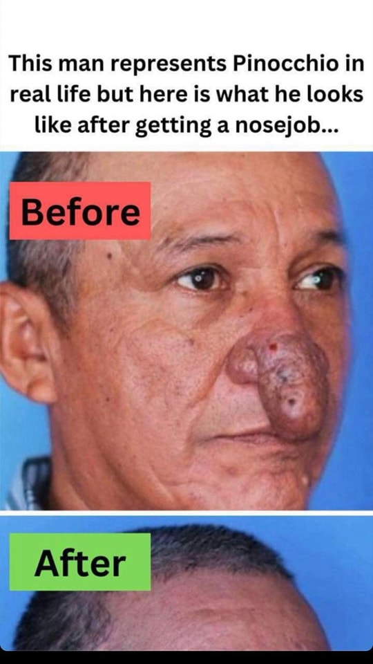 The Remarkable Transformation of Conrado’s Nose