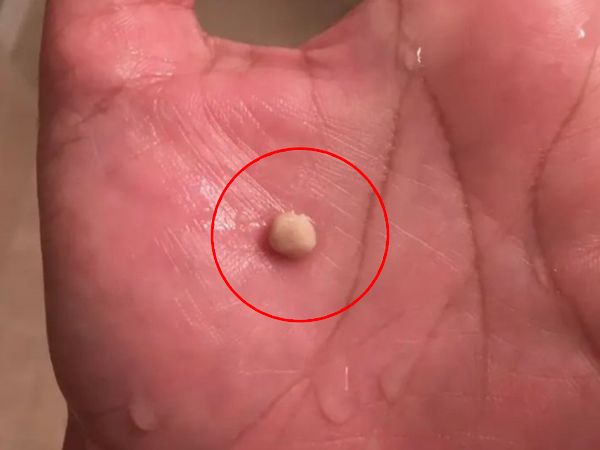 Everything you need to know about tonsil stones, the weird growths that look like pimples in your throat