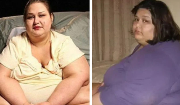 This woman lost a significant amount of weight and here is how she looks after the surgery…