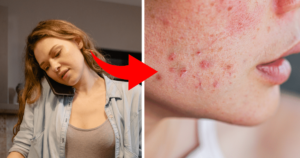 8 Body Parts Where Acne Can Appear and Their Triggers