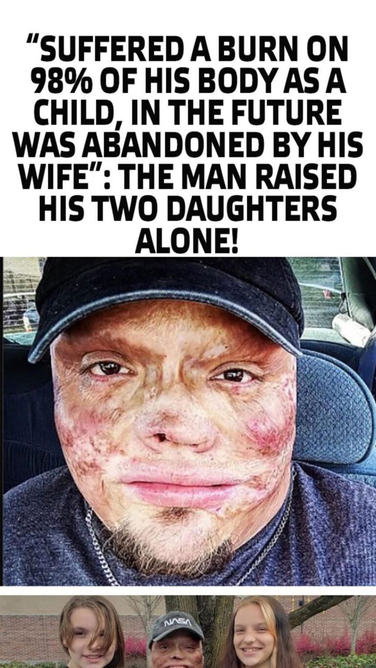 “Suffered a Burn On 98% Of His Body As a Child, In The Future Was Abandoned By His Wife”: The Man Raised His Two Daughters Alone!