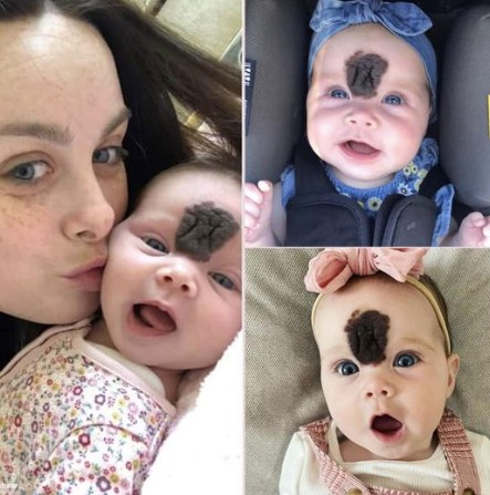 Parents Hid Baby’s Face to Shield Her from Stares — Now, at 2, She Looks ‘Gorgeous’ After Surgery