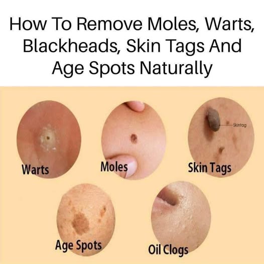 Natural remedies for treating age spots, moles, skin tags, warts, and blackheads